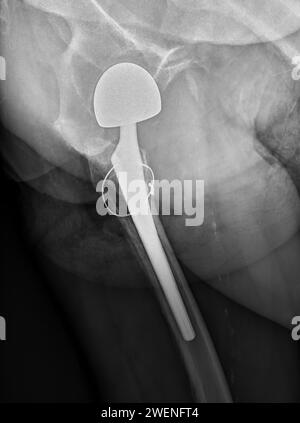 Una radiografia rivela entrambe le articolazioni dell'anca con ARTROPLASTICA DELL'ANCA TOTALE, dimostrando il successo della procedura chirurgica e fornendo un testamento visivo al Foto Stock