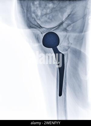 Una radiografia rivela entrambe le articolazioni dell'anca con ARTROPLASTICA DELL'ANCA TOTALE, dimostrando il successo della procedura chirurgica e fornendo un testamento visivo al Foto Stock