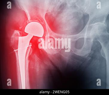 Una radiografia rivela entrambe le articolazioni dell'anca con ARTROPLASTICA DELL'ANCA TOTALE, dimostrando il successo della procedura chirurgica e fornendo un testamento visivo al Foto Stock