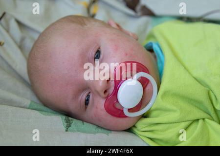 Il bambino giace sulla faccia dell'acne Foto Stock