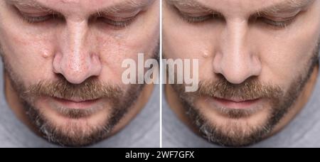 Trattamento Blackhead, prima e dopo. Collage con foto di un uomo, vista ravvicinata Foto Stock
