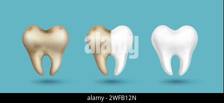 Dente realistico prima e dopo la procedura di pulizia dal dentista - sporco grigio e giallo con macchie e bianco lucido pulito. Insieme vettoriale di denti cattivi e sani per la cura dentale e la progettazione igienica. Illustrazione Vettoriale