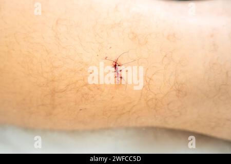 Ferita fresca con punti dopo l'intervento cutaneo Foto Stock