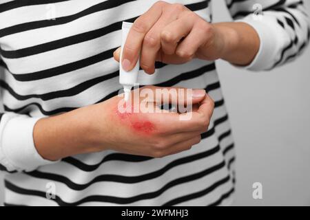 Donna che applica crema curativa sulla mano bruciata su sfondo grigio chiaro, primo piano Foto Stock