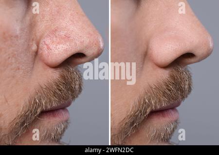 Trattamento Blackhead, prima e dopo. Collage con foto di uomo su sfondo grigio, vista primo piano Foto Stock