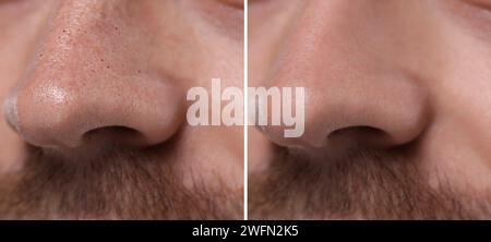 Trattamento Blackhead, prima e dopo. Collage con foto di un uomo, vista ravvicinata Foto Stock