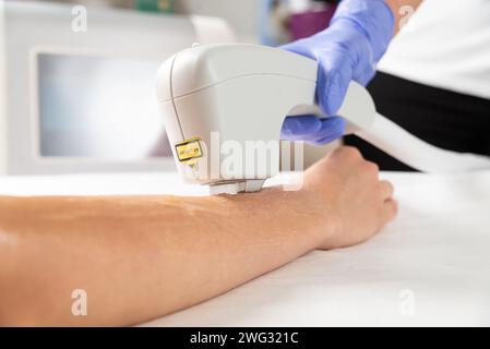 Epilazione laser da mani femminili in un salone di bellezza. Primo piano della procedura di epilazione laser sulle mani di una donna. Foto Stock