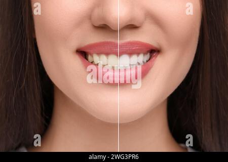 Donna che mostra i denti prima e dopo lo sbiancamento, collage Foto Stock