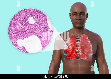 Uomo con polmoni affetti da polmonite, illustrazione Foto Stock