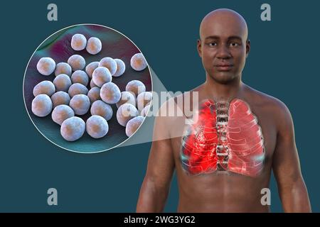 Uomo con polmoni affetti da polmonite, illustrazione Foto Stock