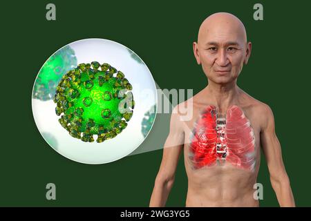 Uomo con polmoni affetti da polmonite da Covid-19, illustrazione Foto Stock