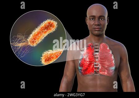 Uomo con polmoni affetti da polmonite, illustrazione Foto Stock