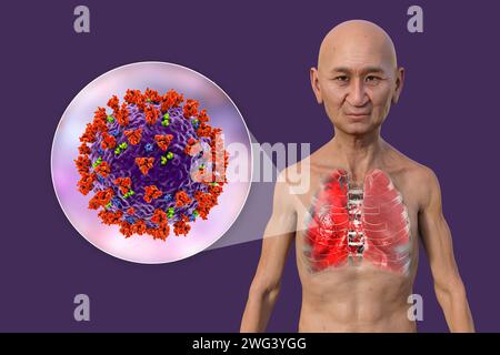 Uomo con polmoni affetti da polmonite da Covid-19, illustrazione Foto Stock