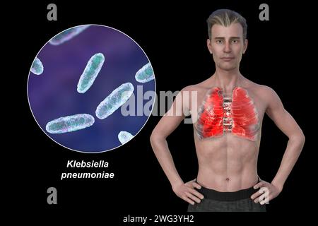 Uomo con polmoni affetti da polmonite, illustrazione Foto Stock
