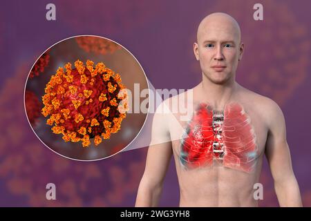 Uomo con polmoni affetti da polmonite da Covid-19, illustrazione Foto Stock