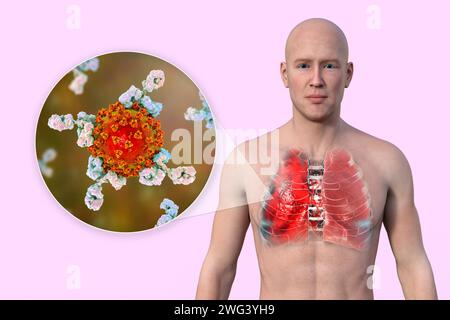 Uomo con polmoni affetti da polmonite da Covid-19, illustrazione Foto Stock