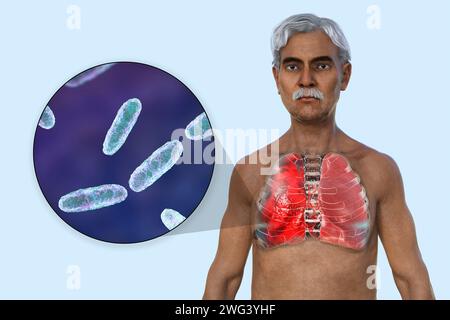 Uomo con polmoni affetti da polmonite, illustrazione Foto Stock