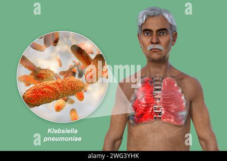 Uomo con polmoni affetti da polmonite, illustrazione Foto Stock
