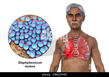 Uomo con polmoni affetti da polmonite, illustrazione Foto Stock