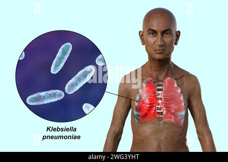 Uomo con polmoni affetti da polmonite, illustrazione Foto Stock