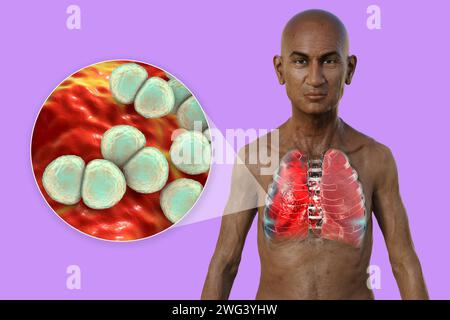 Uomo con polmoni affetti da polmonite, illustrazione Foto Stock