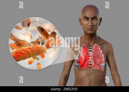 Uomo con polmoni affetti da polmonite, illustrazione Foto Stock