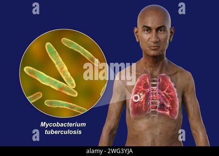 Uomo con polmoni affetti da tubercolosi cavernosa, illustrazione Foto Stock