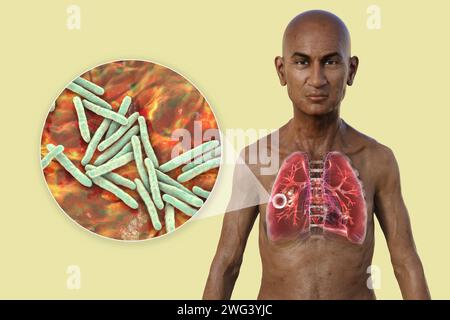 Uomo con polmoni affetti da tubercolosi cavernosa, illustrazione Foto Stock