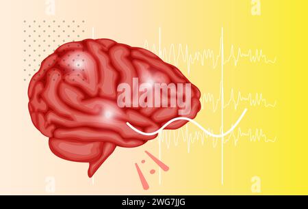 Epilessia - Una condizione neurologica - Stock Illustration as EPS 10 file Illustrazione Vettoriale