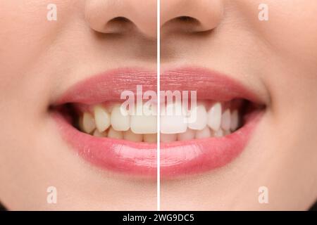 Donna che mostra i denti prima e dopo lo sbiancamento, collage Foto Stock