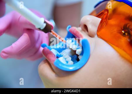 Primo piano del dentista applica il gel ai denti prima di sbiancare i denti. Bella ragazza con gli occhiali di sicurezza. Concetto di sbiancamento dentale e dentale. Foto Stock