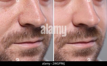 Trattamento Blackhead, prima e dopo. Collage con foto di uomo su sfondo grigio, vista primo piano Foto Stock