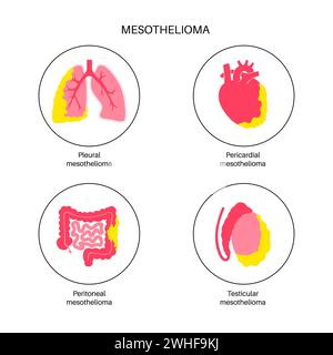 Tipi di tumore mesotelioma, illustrazione Foto Stock