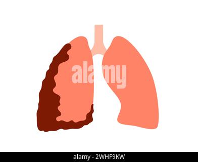 Malattia del cancro del mesotelioma, illustrazione Foto Stock