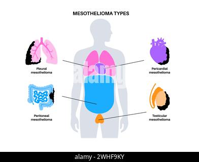 Tipi di tumore mesotelioma, illustrazione Foto Stock