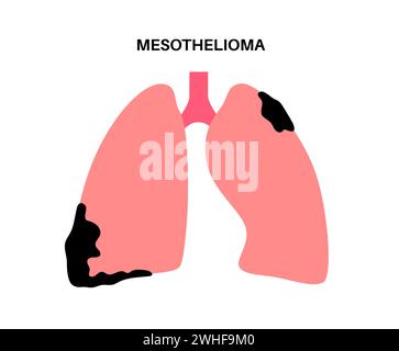 Malattia del cancro del mesotelioma, illustrazione Foto Stock