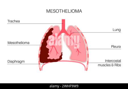 Malattia del cancro del mesotelioma, illustrazione Foto Stock