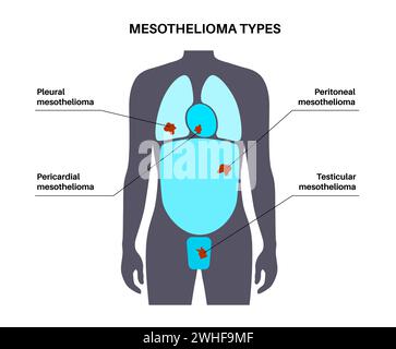 Tipi di tumore mesotelioma, illustrazione Foto Stock