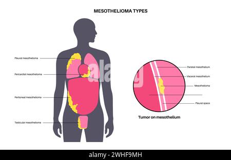 Tipi di tumore mesotelioma, illustrazione Foto Stock