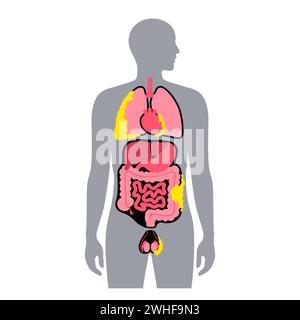 Tipi di tumore mesotelioma, illustrazione Foto Stock