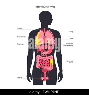 Tipi di tumore mesotelioma, illustrazione Foto Stock