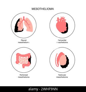 Tipi di tumore mesotelioma, illustrazione Foto Stock
