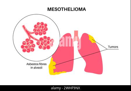 Malattia del cancro del mesotelioma, illustrazione Foto Stock