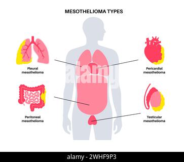 Tipi di tumore mesotelioma, illustrazione Foto Stock