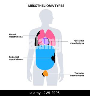 Tipi di tumore mesotelioma, illustrazione Foto Stock