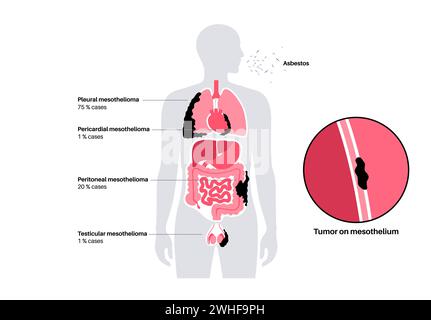 Tipi di tumore mesotelioma, illustrazione Foto Stock