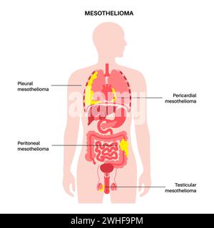 Tipi di tumore mesotelioma, illustrazione Foto Stock