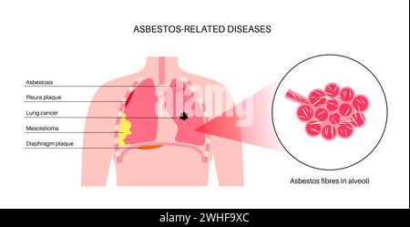 Malattie correlate all'amianto, illustrazione Foto Stock