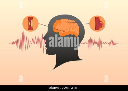 Concetto di malattia da ictus. Ischemico ed emorragico. Illustrazione medica scientifica di ictus cerebrale umano. Illustrazione vettoriale. Illustrazione Vettoriale