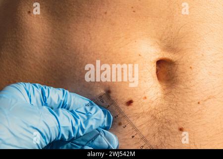 Dermatologo che controlla le dimensioni delle voglie maschili con il righello. Medico che esamina la lunghezza e la larghezza dei nei benigni sulla pigmentazione cutanea dell'uomo. Foto Stock